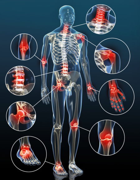 Grafik Eine für Rheuma, Gicht und Arthrose Naturheilkunde Köthen